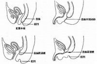 肛门闭锁常见问题解答（下）——小儿外科专家王勇科普系列