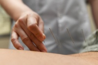 针灸保健：古老智慧与现代生活的完美结合