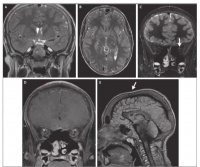 12 岁男孩突发视力下降，病因 90% 的医生都猜错了