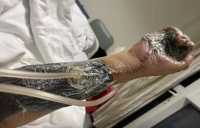 24岁小伙上班6天误触辐射源，右手腐烂可能截肢，公司曾让他放弃维权