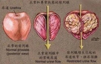 冬季日常生活如何呵护前列腺健康