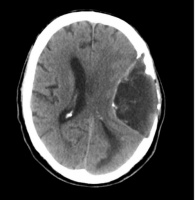 老年男性头痛，颅内发现巨大占位，居然没有其他症状？