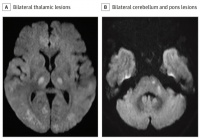 患者反复高热入院，治疗无效，直到查体发现一块痂……