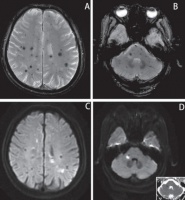 老年患者右侧肢体无力入院，MRI 结果难倒主任