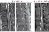 患者突发背部疼痛,查了一圈居然是肿瘤,医生感叹:怎么跑过去的?