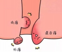 关注肛肠健康,提升生活质量