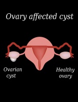 多囊卵巢综合征的饮食和生活方式