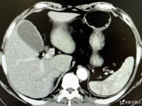 掀开被子一看，值班沉默了，带教怒斥：只看一眼就能诊断，再等就死人了