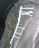 糟了！引流管断在患者体内，主任惊出一身汗，该怎么给患者解释？