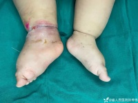 戴了奶奶送的银镯，8 月患儿上了手术台？真相令人大吃一惊