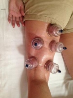 拔罐的最佳时间是什么时候 几点分析教你健康养生