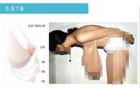 乳房下垂能治好吗？