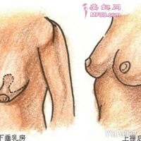 胸下垂恢复很简单简单妙招让你重拾女人的魅力