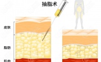 西安吸脂好的医生排名公布，王爱武、王俊河、朱健康、王仁根等人上榜