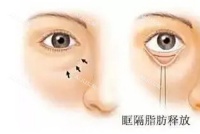 双眼皮做吸脂大概多少钱？2k~2w元不等，根据地区差异/医生资质/手术方法/个人情况等价格有所差异