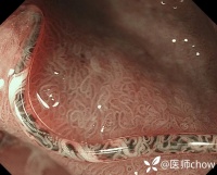 胃镜下可见密密麻麻的「虫子」，只看了一眼我就全身发麻