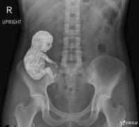 74 岁女子「怀孕」30 多年，一看 CT 惊呆了，主任：极其罕见