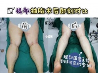 华美吸脂减肥法：科技带来的美丽变革