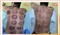 平衡火罐：从适应症到禁忌症，一文读懂拔罐疗法