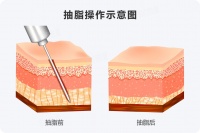 大腿抽脂肪之后多久可以恢復(fù)正常