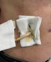 糟了！术后 T 管拔不出来了