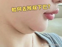 如何去除雙下巴？ 去除...@皮膚科蘇騰良醫(yī)生的動態(tài)