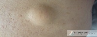 Lipoma Surgery Questions Answered