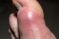 腳趾撞傷一個(gè)月不消腫