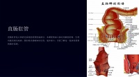 《直腸肛管》課件