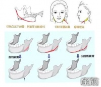 医美V脸塑形术：手术与非手术方式有何不同？