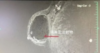 61歲女子乳房“再發(fā)育”，又大又硬！竟與25年前的隆胸有關(guān)……