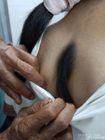 女童后背長出「頭發(fā)」，越來越長，同行直呼：趕緊做這項檢查