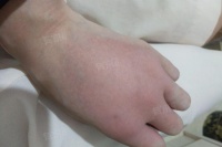 手腫怎么消腫最快