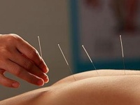 女人針灸減肥多久一個療程