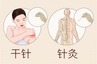 中醫(yī)解答針灸減肥三大疑惑