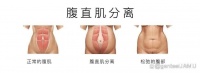 腹直肌分离你一定要懂！