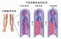 靜脈血栓栓塞癥（VTE）預(yù)防