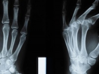 手腕天天加班？四步預防疼痛遠離腕管綜合征