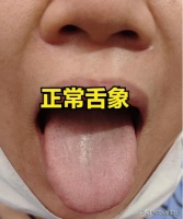 中醫(yī)蔣主任：肝郁氣滯分四大階段，程度不同，舌象表現(xiàn)不同，中醫(yī)一次講明白！
?
程度（從輕到重）：氣滯點——化熱點——肝火點——瘀血點
?
?
氣滯點——肝郁剛開始的第一個階段
?
舌象：舌邊鼓脹，舌邊會有一色小而色淡的氣泡點
?
表現(xiàn)：胸悶脅脹，情緒壓抑，悶悶不樂，口干口苦等
?
調(diào)理：可以參考柴胡疏肝散辨證加減來疏肝解郁
?
化熱點——肝郁的第二個階段，郁久化熱，形成肝郁化熱
?
舌象：舌邊會有...