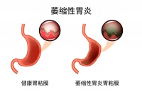 新津哪家診所針灸減肥