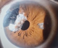 服用前列腺藥物未告知 60歲男白內(nèi)障手術(shù)險(xiǎn)「更嚴(yán)重」