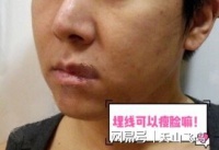 埋線可以瘦臉嗎，老鐵！線雕提升一周后的圖片，沒(méi)毛??！