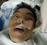 喝下 2 瓶啤酒后，意識模糊口吐血色泡沫，入院搶救無效死亡