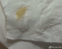 患者咳出晶瑩剔透「葡萄樣」的痰，主任：太典型了