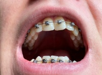 矫正牙齿对身体有影响吗