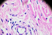 胰岛素抵抗怎么减肥，特殊情况下的减重策略