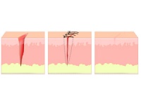 顺产伤口撕裂怎样护理？
