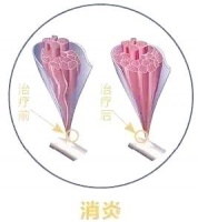 銀質(zhì)針療法的原理與應(yīng)用：綠色健康的新型療法