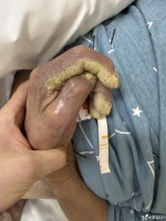 百歲老人雙手雙足長滿「抹茶」，站友怒斥：接診醫(yī)生心真大，已顛覆認(rèn)知…