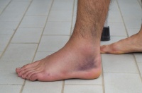 脚胖、水肿别乱试偏方！这份安全瘦脚指南，让你穿鞋更自在